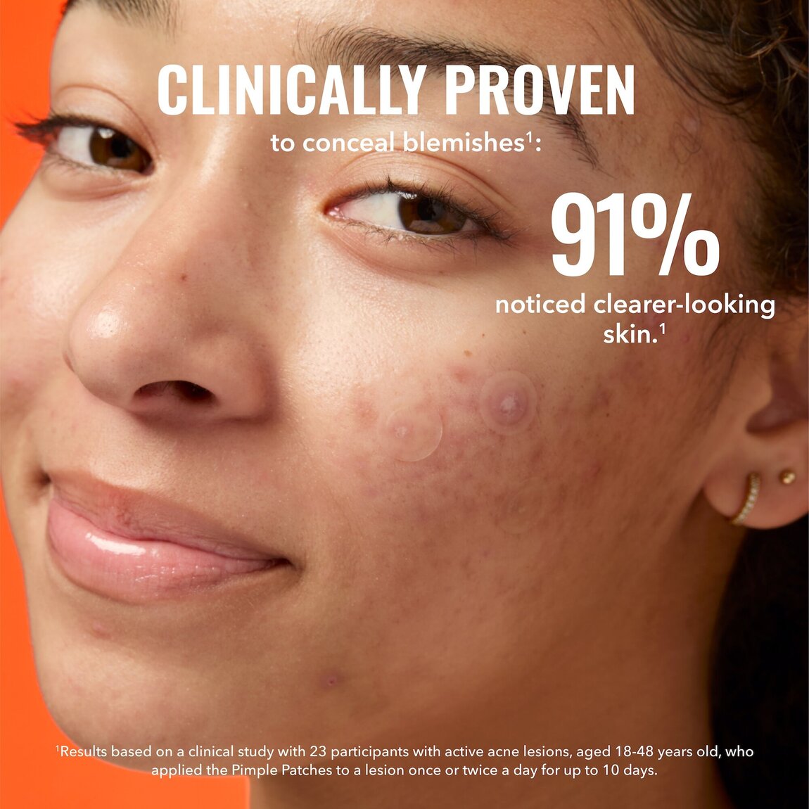 pimple-patches-b5 zb_p.jpg
